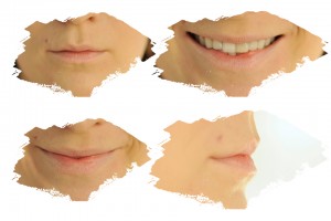 powiększanie ust efekt przed i po