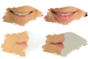 powiększanie-ust-efekt-przed-i-po