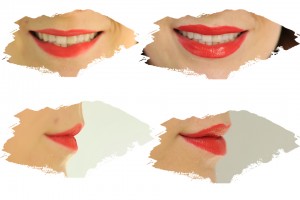 powiększanie-ust-efekt-przed-i-po